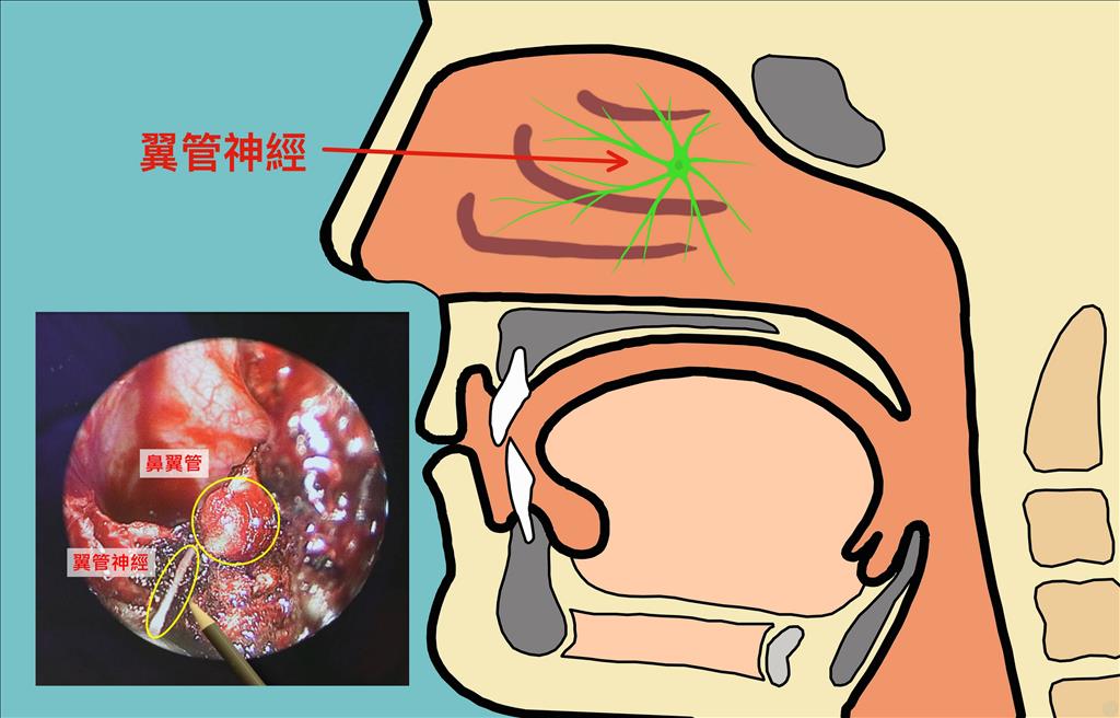 翼管神經位置示意圖